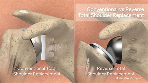 reverse shoulder arthroplasty orthobullets|Stemless reverse total shoulder arthroplasty: a  .